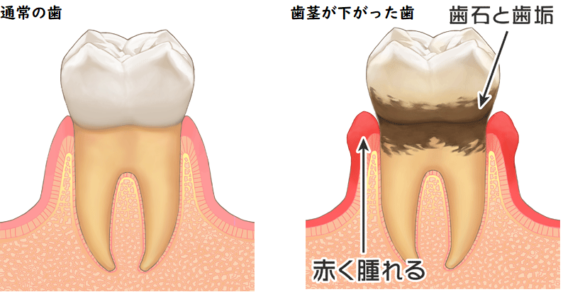 口がうんちくさいと言われたあなたへ！【口臭の対策と予防方法】